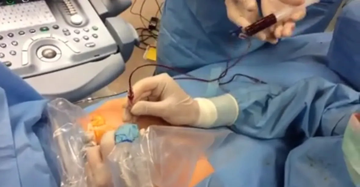 VIDEO: Lékaři z Podolí operují děti ještě v těle matky, nejčastěji dvojčata