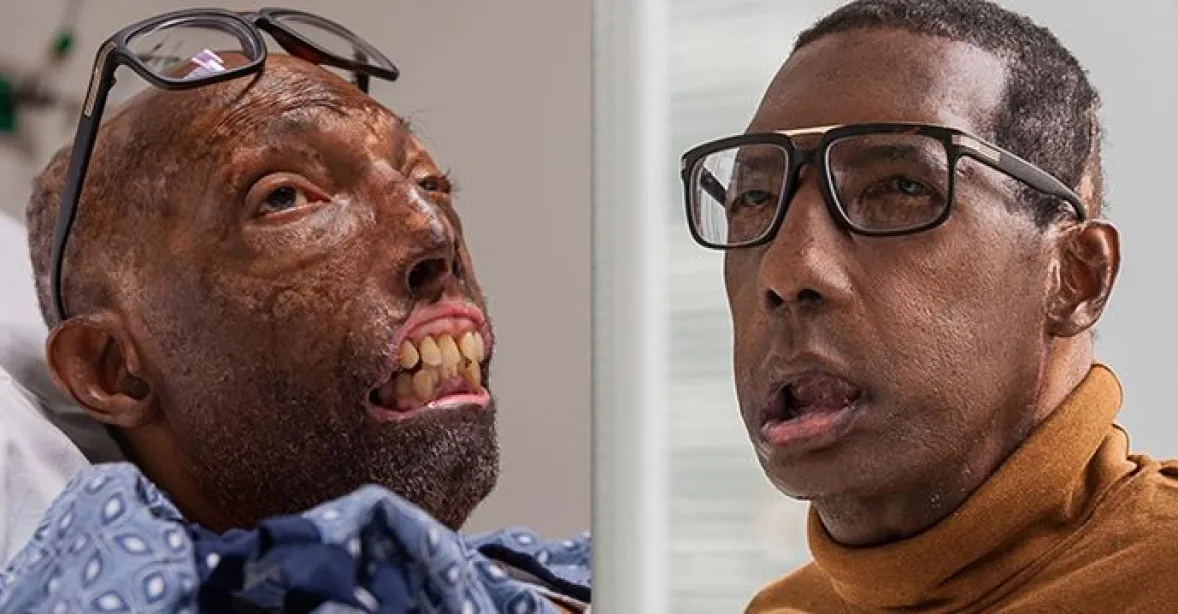 Pomahačův tým transplantoval obličej prvnímu černochovi a současně nejstaršímu člověku