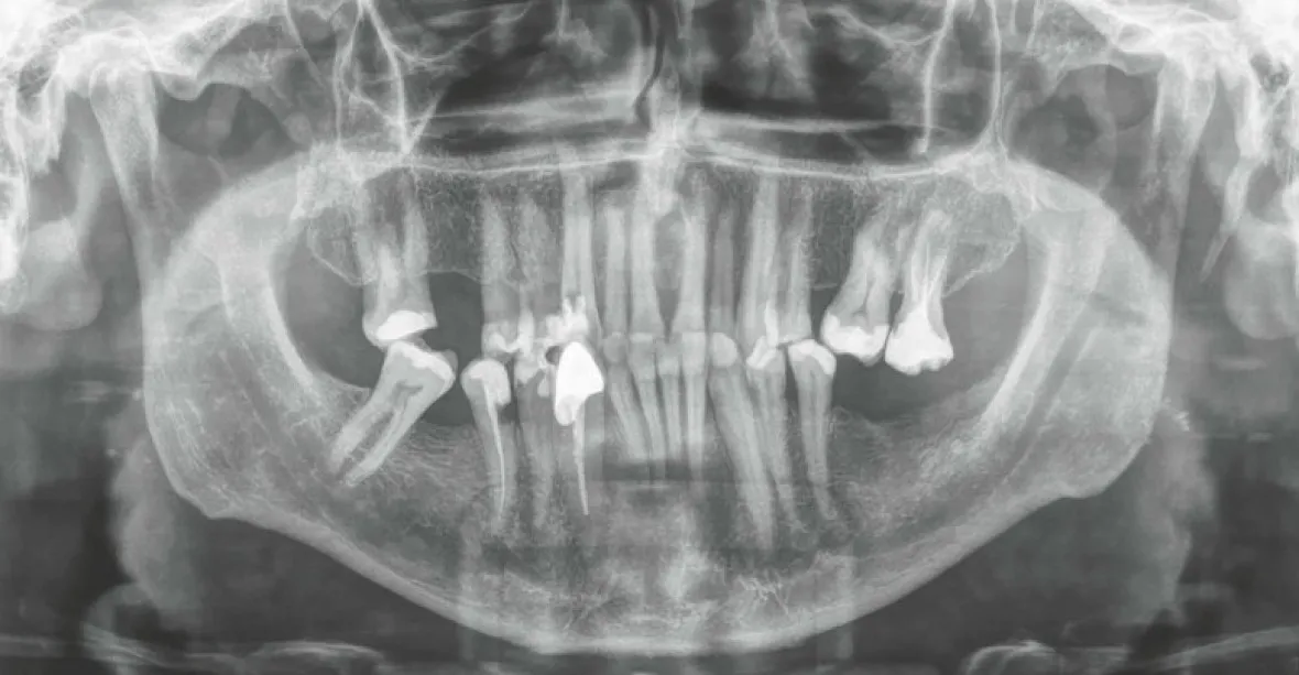 Zubař vytáhl pacientovi nejdelší zub na světě, měří přes 37 milimetrů