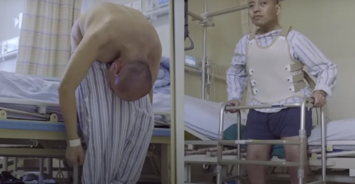 VIDEO: „Složený muž“ žil 28 let ohnutý ke kolenům. Nyní se může znovu postavit